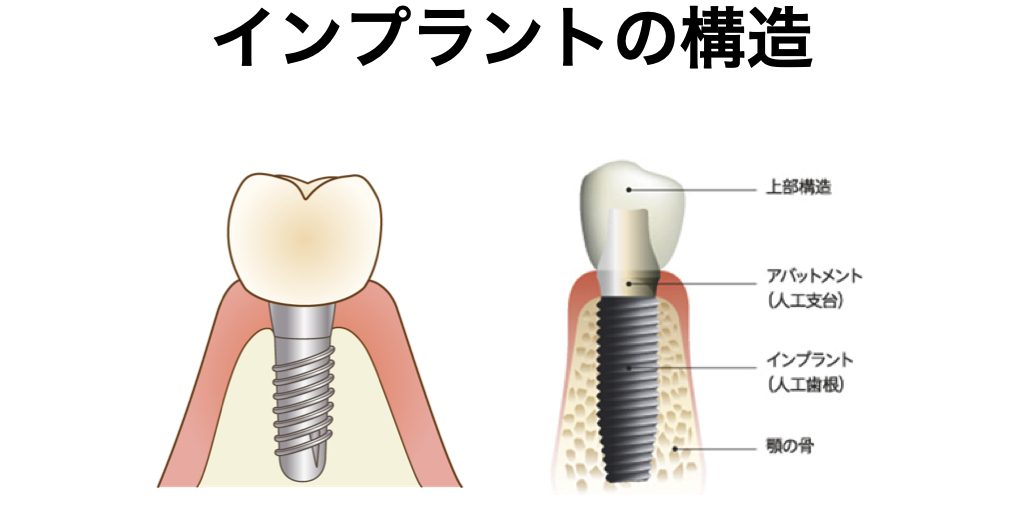 シリーズインプラント.001